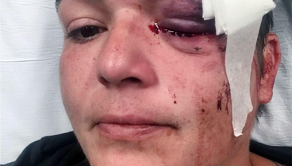 Linda Tirado says she is now blind in her left eye after being shot by police at protests in Minneapolis. Photo courtesy of Linda Tirado.